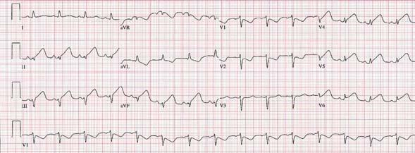 tall R waves (black arrows) with ST depression and T wave inversions (blue arrows) in V 1 and V 2.