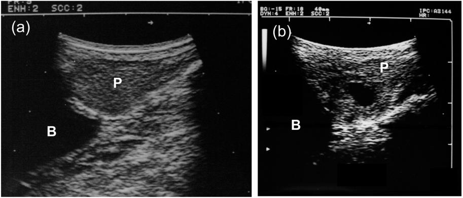 TRANSRECTAL SPLIT-FOCUS HIFU ABLATION 843 Fig. 5. (a) Sagittal image of prostate observed by transrectal ultrasonography just before HIFU ablation.
