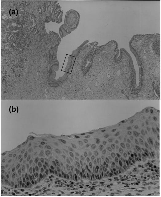 3(b), we found that HIFU exposure can cause acute thermal coagulation of prostatic tissues in dogs.