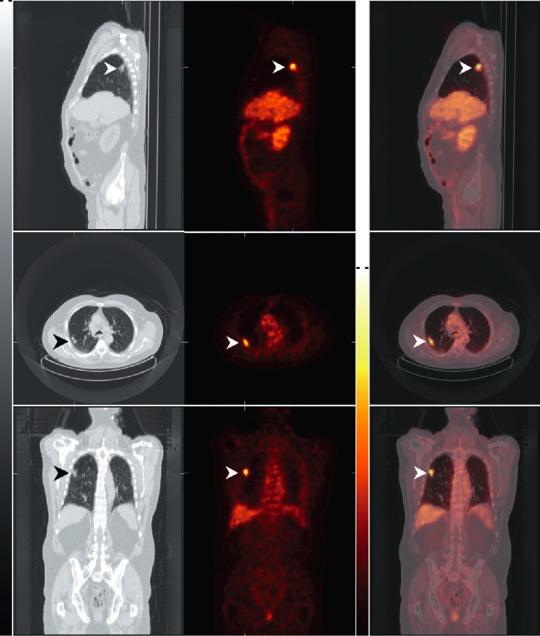Prostate Cancer - Staging Local staging is poor compared to MRI 2. (detection of ECE PET 22% vs MRI 63%) FDG-PET is not accurate at detecting occult metastases in regional lymph nodes 3.