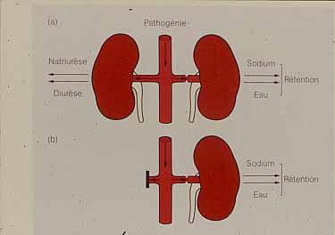 Two variants of renovascular hypertension Côté de la One sténose clip Two kidneys - Natriuresis Sodium Retention Diuresis Water Blood volume