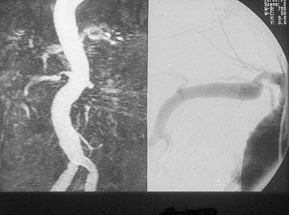 MRI Selective angiography * Left nephrectomy for cancer (*). History of coronary bypass. Serum creatinine 210 µmol/l.
