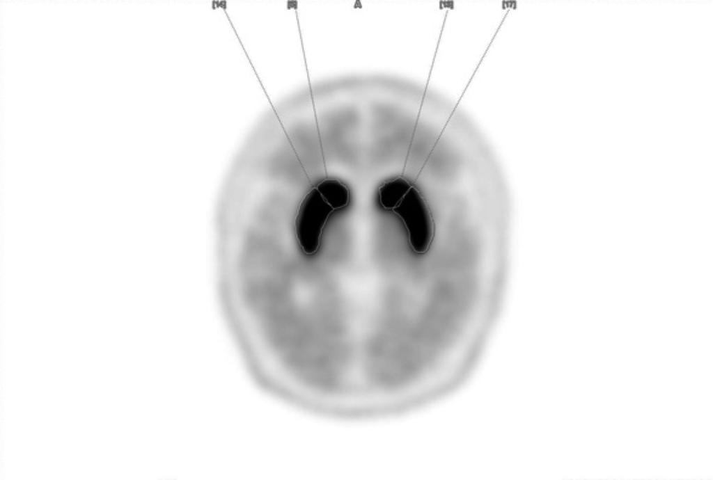 Image analysis The regions of interest (ROI) (caudate,, and cerebellum) were identified in both hemispheres on realigned MR images (1.