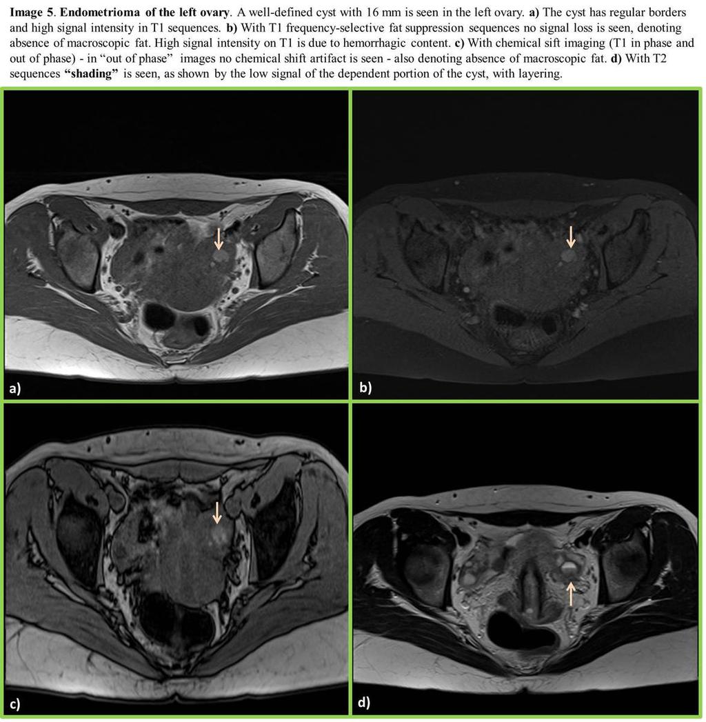 Fig. 5: Endometrioma of the left ovary Department of Radiology,