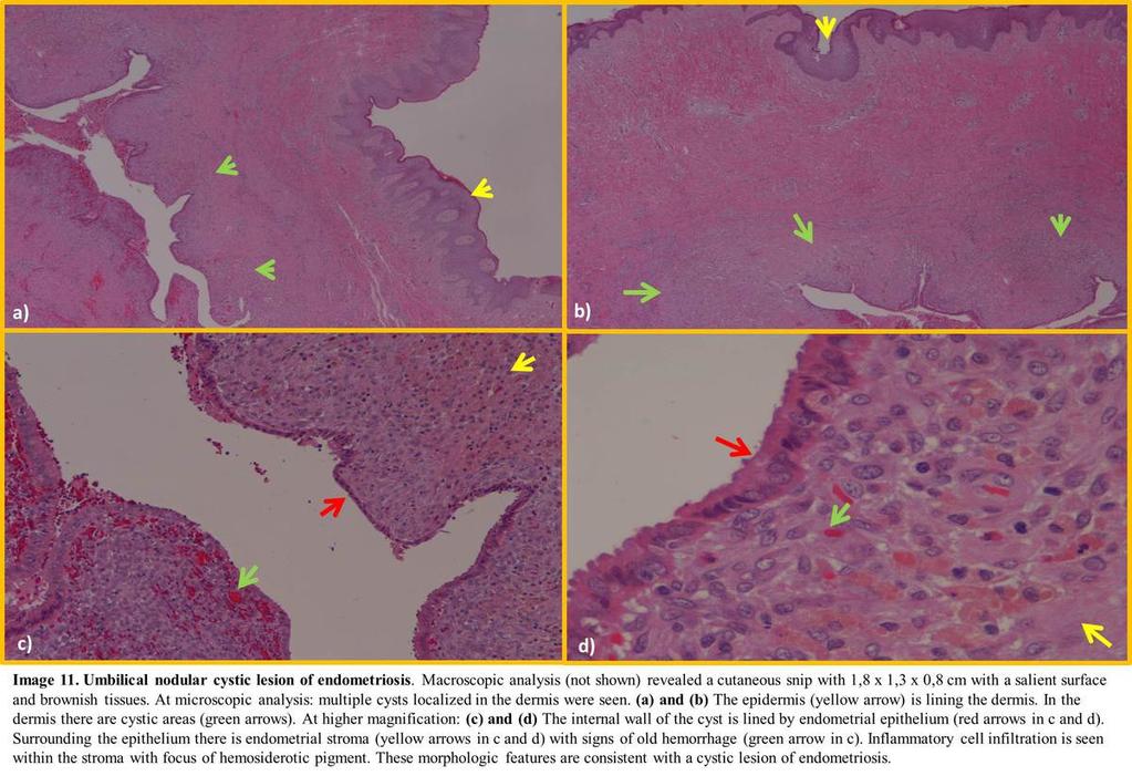 Fig. 11: Histopathologic findings of a cutaneous lesion of endometriosis Clinical