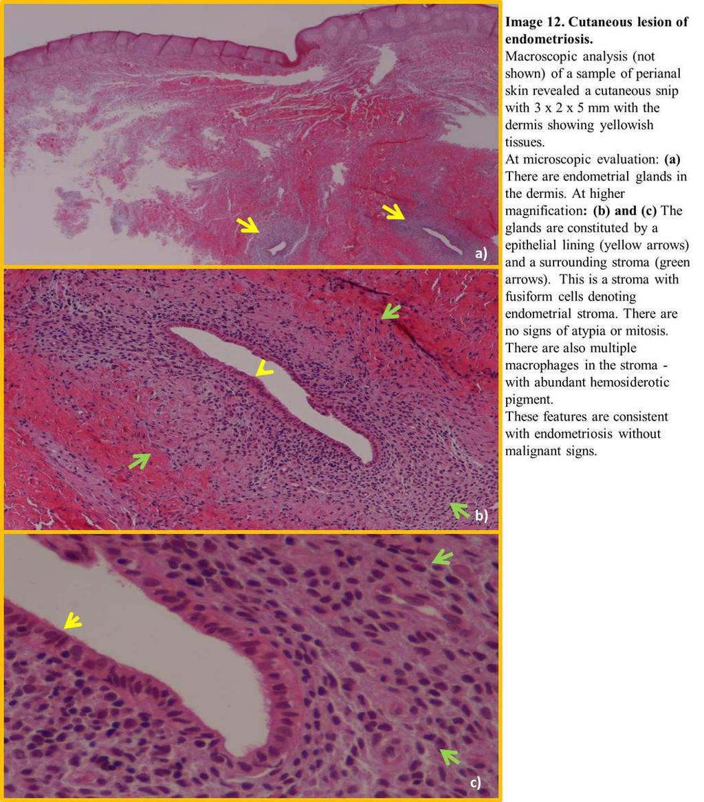 Fig. 12: Histopathological findings in a cutaneous lesion of endometriosis Clinical