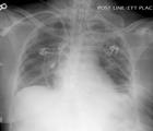 Dyspnea (77%) Hypertension (43%) 0 2 desaturation (36%) Diagnostic Criteria #1 Hypoxemia: Pa0 2 /Fi0 2 <90% on room air Bilateral infiltrates on CXR in presence of clinically evident left atrial