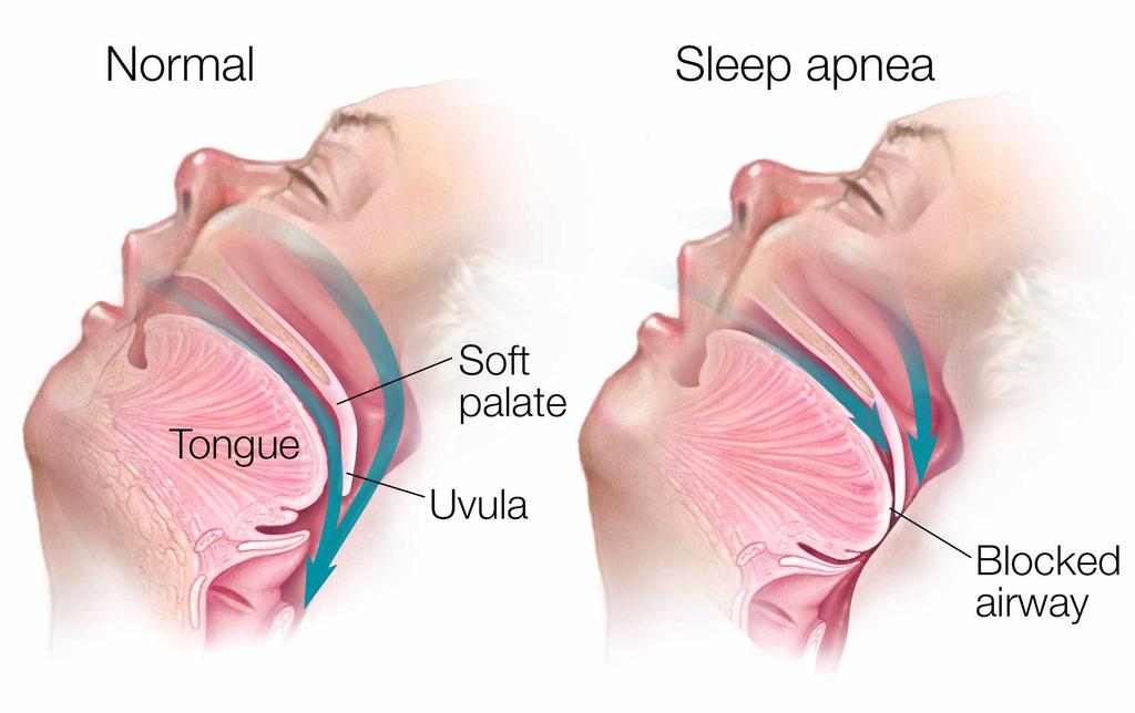 Attention: The Combination of Sleep Apnea and Diabetes May Be Deadly Sleep apnea very common in people with diabetes and its treatment can reduce risk of cardiovascular disease.