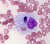 eliminate activated macrophages Familial Hemophagocytic Lymphohistiocytosis Mutations in genes