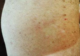 erythematous papules 7 Juvenile idiopathic arthritis + DOD - Alive rash -