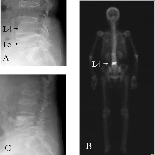 Li et Fig. 2: (A) Type I osteoporotic vertebral fracture at L1 level and type IIa fracture at L4 level.