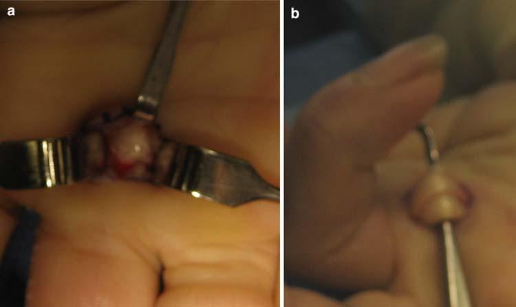 Curr Rev Musculoskelet Med (2008) 1:92 96 95 Fig. 3 (a) Intra-operative photo showing a thickened A1 pulley prior to release.