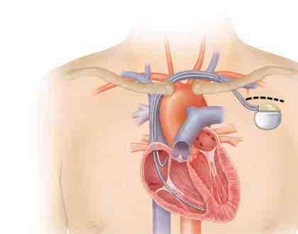 During the Procedure The most common method for implanting a pacemaker is called endocardial ( inside the heart ) implantation.