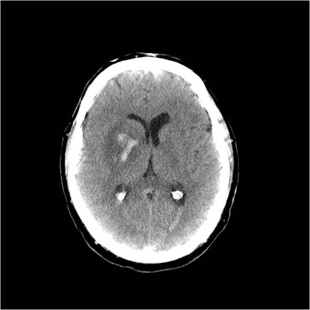 Fig. 12: Hemorrhage in basal ganglia and right