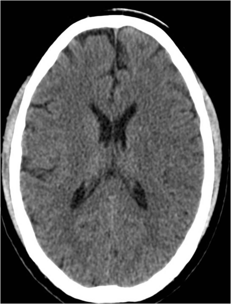 Fig. 5: Hypodense areas of middle cerebral artery territory left ill-defined with