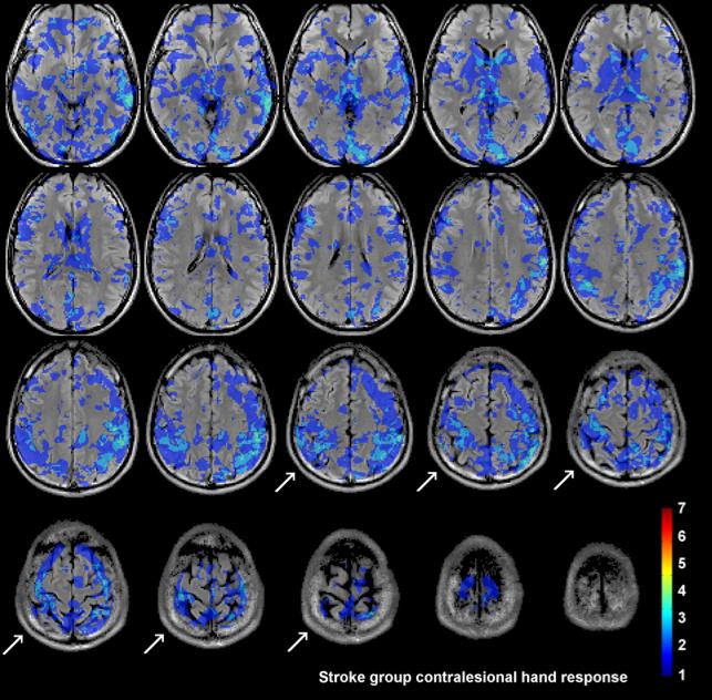 Results Identified brain regions: STROKE GROUP - as expected, responses are sparse and inconsistent - Rossini et al (2003), Brain provide compelling evidence of neurovascular dysfunction