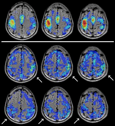 NORMAL GROUP left Results Identified brain regions References: Contralateral SMC: - Kandel et al. (2000) SMA: - Nachev et al. (2008) Ipsilateral premotor & parietal: - Reis et al.