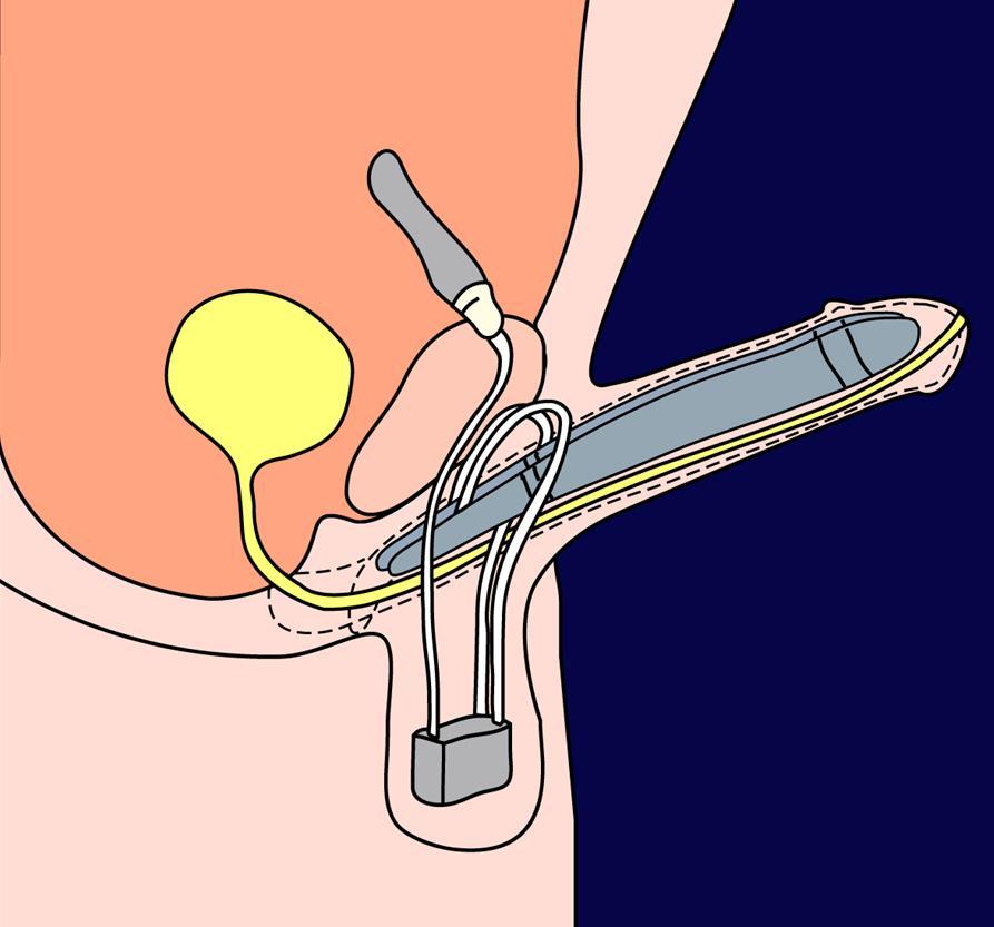 Penile prosthesis Reservoir Multi-