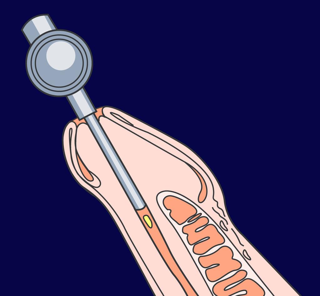 Intraurethral (IU) therapy - alprostadil MUSE (Medicated Urethral System for Erection) Pellet of alprostadil inside