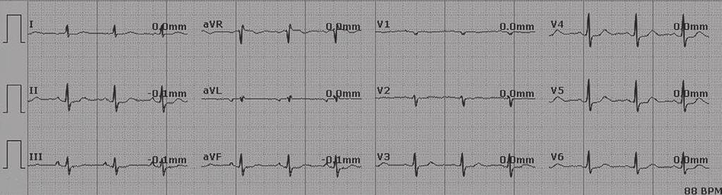 (a) (b) (c) Figure 1 (a) Baseline 12-lead electrocardiography of a patient with post-endoscopic retrograde cholangiopancreatography (ERCP) myocardial infarction.