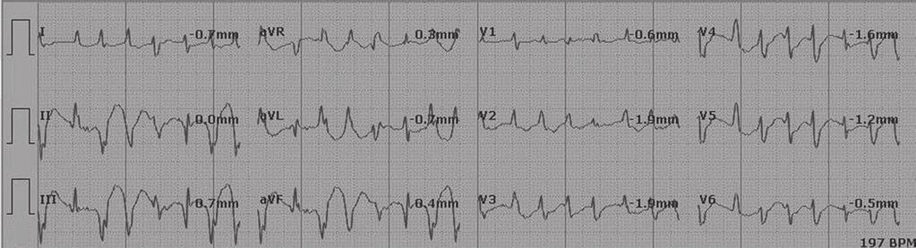(c) Significant ST depression over V2-V6 and inferior leads following short-run VT during ERCP on Holter monitoring.