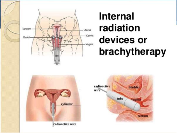 Radiation therapy Brachytherapy Radiation to the