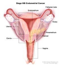 Stage II Invades Cervical Stroma www.cancer.