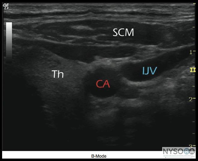 Ultrasound Image Modes B-Mode or brightness modulation and is the primary mode used in regional anaesthesia It creates a two dimensional image by simultaneously scanning 100-300