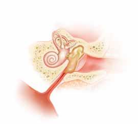 When Fluid Builds Up What is called a middle ear infection can be one of two types of middle ear problems: otitis media with effusion (OME) and acute otitis media (AOM).
