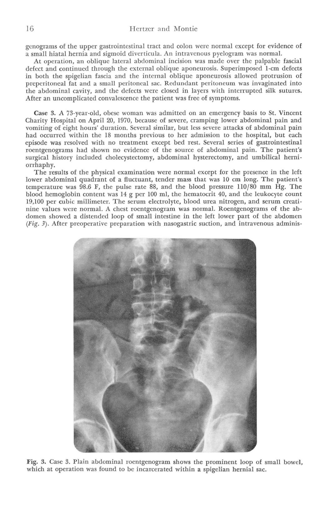 16 Hertzer and Montie gcnograms of the upper gastrointestinal tract and colon were normal except for evidence of a small hiatal hernia and sigmoid diverticula. An intravenous pyelogram was normal.