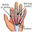 Intersection Rest Splint Injection Surgical release 19 Trigger Finger Stenosing Tenovaginitis Entrapment of the tendon in it s fibrous sheath Thickening of the entrance of the flexor