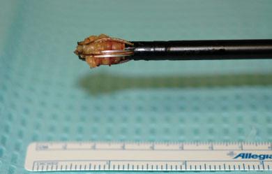 946 CANCER September 1, 2006 / Volume 107 / Number 5 FIGURE 1. The 10-mm wand from the Breast Lesion Excision System. the accuracy of the percutaneous breast biopsy techniques.