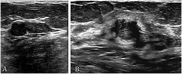 6 Isoechoic 0 0 0 0 Echogenicity Hyperechoic 0 0 0 0 Mixed 2 9.1 5 9.4 Figure 2: A. Mammogram of right breast [MLO view] of Parallel to skin 14 63.6 21 39.