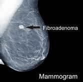 Mammographic features Benign lesions Benign masses are often round or