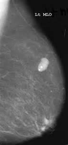 Benign calcifications are usually large The presence of very low