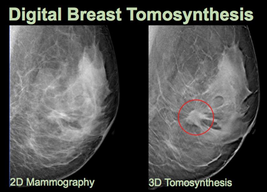 Digital breast tomosynthesis DBT, also known as 3D mammography, uses the same compression views as 2D mammography and adds a 3D volume acquisition.