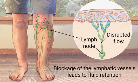 At the Lymphedema Clinic, we perform Complete Decongestive Therapy, which consists of: Manual Lymph Drainage (MLD) Compression Therapy Exercise Skin & Nail Care Instructions in Self Care MLD is a