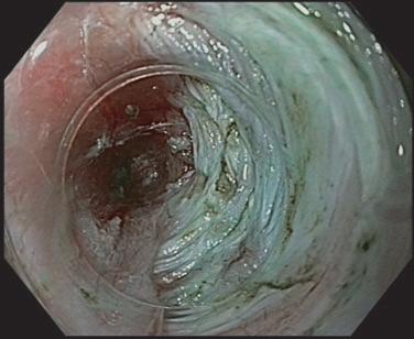 In case of severe injury, it is contraindicated to continue with the myotomy because of the risk of full-thickness perforation after completion