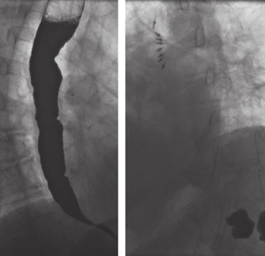 A. J. Bredenoord et al. Neurogastroenterology and Motility A B aged by placing a desuflation needle through the abdominal wall into the peritoneum.