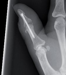 Base Fracture of the