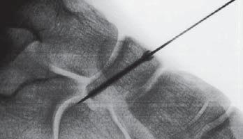 mm Intraoperative X-ray Insertion of