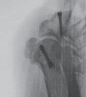 0 CCS X-ray, 6 weeks postoperative Case 14 DIP