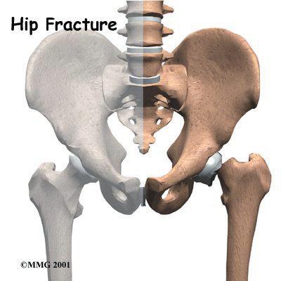 Introduction As the population ages, the number of hip fractures that occur each year rises. A fracture of the hip in an aging adult is not simply a broken bone. It is a life-threatening illness.