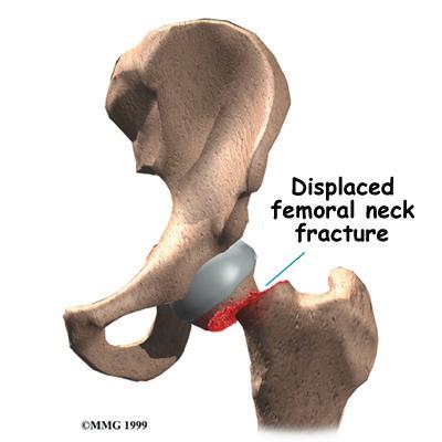 This approach helps align the bones and displaced, there is a very high chance that the blood supply to the femoral head has been damaged.