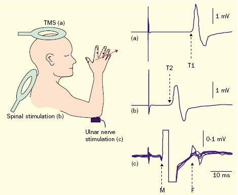 Transcranial Magnetic Stimulation (TMS) CMCT= Scalp Latency