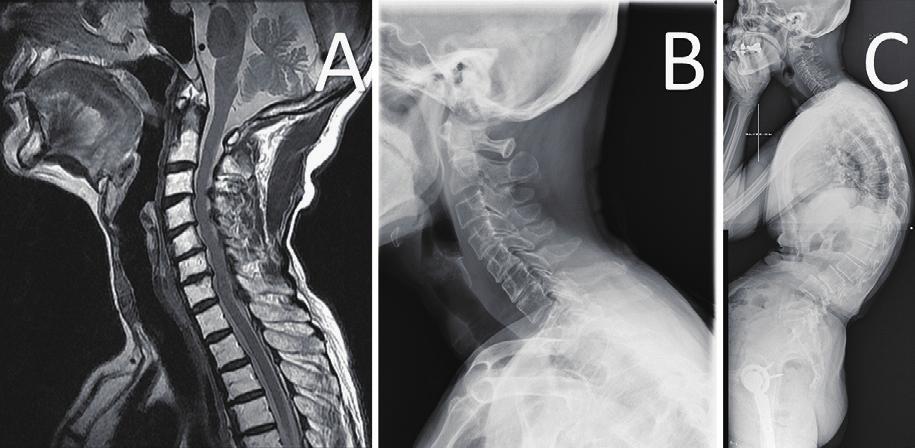 Figure 1. Preoperative images. (A) Sagittal T2-weighted MRI shows multilevel cervical cord compression.