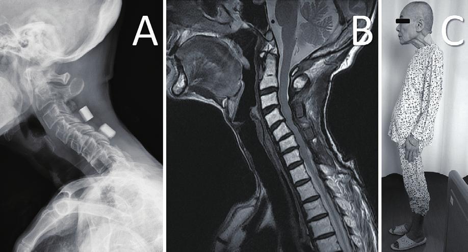 Figure 2. Images after first operation (cervical laminoplasty from C3 to C7). (A) X-ray at 10 months shows development of a cervical kyphotic alignment change combined with cervical disc degeneration.