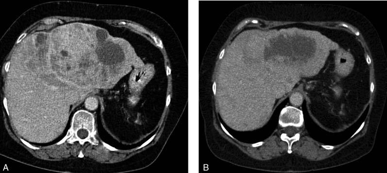 Liver Embolization with Embosphere in Patients with Neuroendocrine Tumors 183 Fig. 2. A.