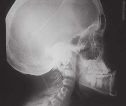 Figure 5: Lateral cephalogram showing maxillary hypoplasia, mandibular