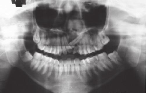 by Quarrell Figure 10: Lateral cephalogram showing maxillary hypoplasia,